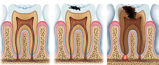 Endodoncija (lečenje zuba)