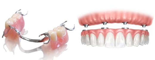 Zubna proteza prikaz